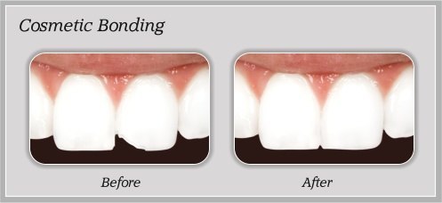 Cosmetic Bonding before and after by Douglas J. Snyder DDS, PC in Elkhart, IN