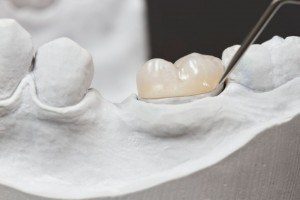 Dental Crown Placement by Douglas J. Snyder DDS, PC in Elkhart, IN