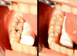 Cavity Filling In Brooklyn Ny Dental Composite Fillings