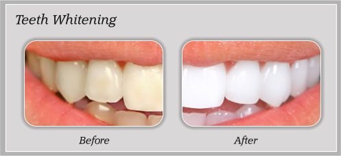 Teeth whitening before and after by Douglas J. Snyder DDS, PC in Elkhart, IN