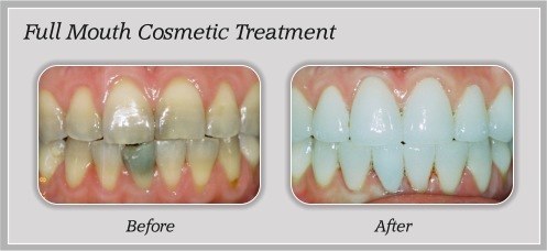 Full Mouth Cosmetic before and after by Douglas J. Snyder DDS, PC in Elkhart, IN