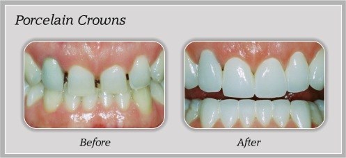Porcelain Crowns before and after by Douglas J. Snyder DDS, PC in Elkhart, IN