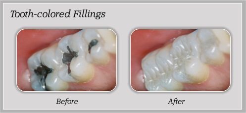 Tooth-colored Fillings before and after by Douglas J. Snyder DDS, PC in Elkhart, IN
