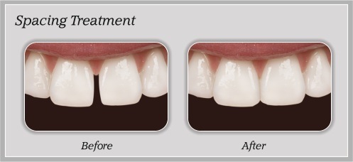 Spacing Treatment before and after by Douglas J. Snyder DDS, PC in Elkhart, IN