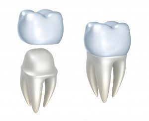 Dental Crowns by Douglas J. Snyder DDS, PC in Elkhart, IN