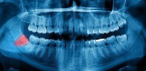 Wisdom Tooth Therapy by Douglas J. Snyder DDS, PC in Elkhart, IN