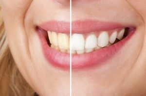 Laser Teeth Whitening by Douglas J. Snyder DDS, PC in Elkhart, IN